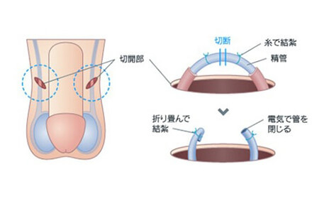 2か所切開法